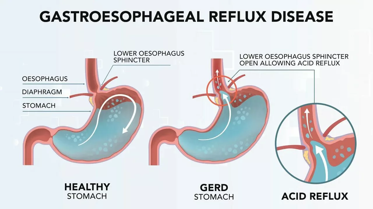 Zollinger-Ellison Syndrome and Gastroesophageal Reflux Disease (GERD): What's the Connection?