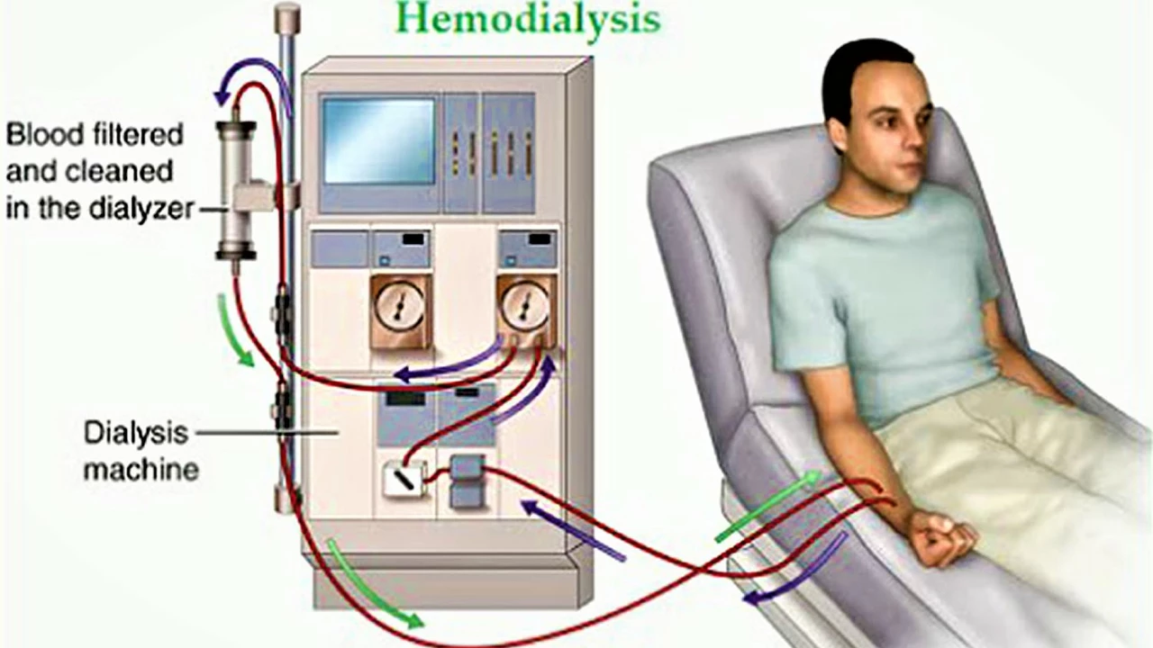 Sevelamer Hydrochloride and its impact on dialysis treatment